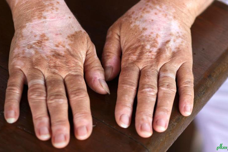 বেশির ভাগ ক্ষেত্রেই শ্বেতি হয় অতিরিক্ত রাসায়নিক ব্যবহারের কারণে। 