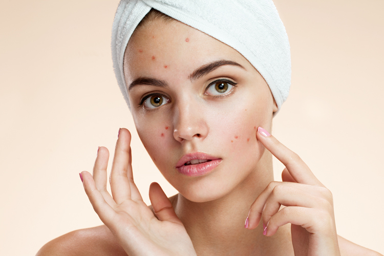 Sleeping mistakes that trigger acne