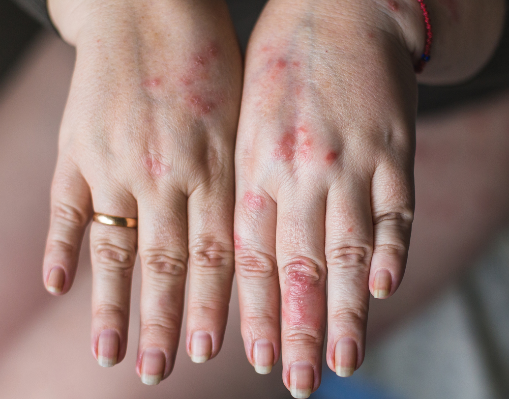 ডায়াবিটিক বিশেষজ্ঞ সমীর রায়চোধুরীর মতে, রক্তে শর্করার পরিমাণ বেড়ে গেলে অনেক সময় শরীরে লাল, বাদামি বা হলদেটে দাগ দেখা যায়। একে চিকিৎসার পরিভাষায় ‘নেক্রোবায়োসিস লিপিডিক’ বলা হয়। ডায়াবিটিস হানা দেওয়ার আগে অনেকের শরীরেই এমন দাগ হয়। তেমন হলে সচেতন হোন তখনই। ছবি: শাটারস্টক।