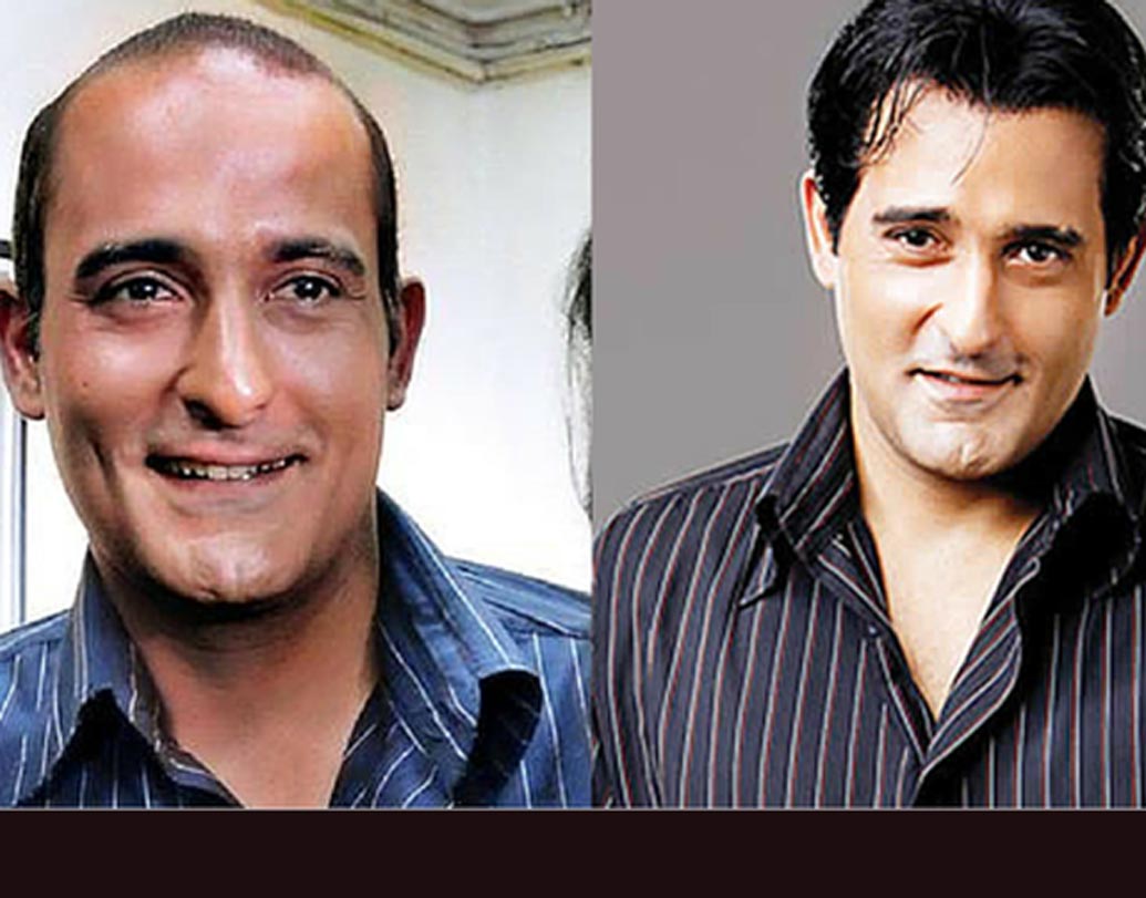 অক্ষয় খন্না: হেয়ার ট্রান্সপ্ল্যান্ট করিয়েছেন নাকি অক্ষয়ও। তবে তা খুব একটা কাজে দেয়নি। ‘দিল চাহতা হ্যায়’-এর সময় থেকেই ওই লুকসটাই একটু অদলবদল করে ‘টাক’-কেই দিব্যি ‘ক্যারি’ করছেন ‘ইত্তেফাক’ অভিনেতা।