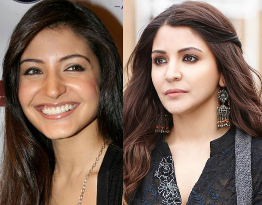 ২০০৮-এ ‘রব নে বনা দি জোড়ি’ দিয়ে বলিউডে পা দিয়েছিলেন অনুষ্কা শর্মা। কয়েকটি ছবি করার পরই প্লাস্টিক সার্জারি করে নিজের লুকও বদলে ফেলেন নায়িকা। এখনও বলিউডে অত্যন্ত প্রাসঙ্গিক অনুষ্কা। ইতিমধ্যে বিয়েও করেছেন ভারতীয় ক্রিকেট আইকন বিরাট কোহালিকে।