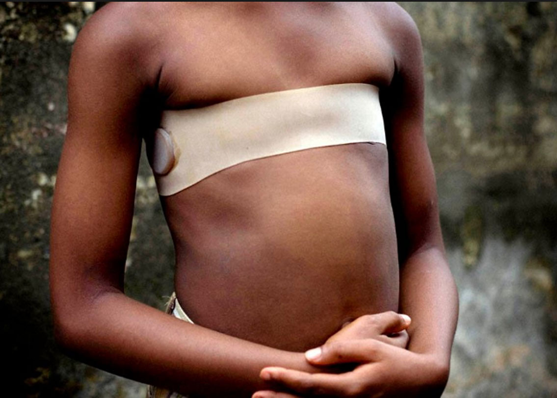 এ ভাবে বারবার গরম ছ্যাঁকা দিলে স্তনের কোষগুলো ভেঙে যায়। কোষের বৃদ্ধি হ্রাস পায়। এক জন কিশোরী উপর সপ্তাহে এক বার বা দু’বার বা প্রয়োজন বুঝে তিন বারও এই পদ্ধতি প্রয়োগ করা হয়।