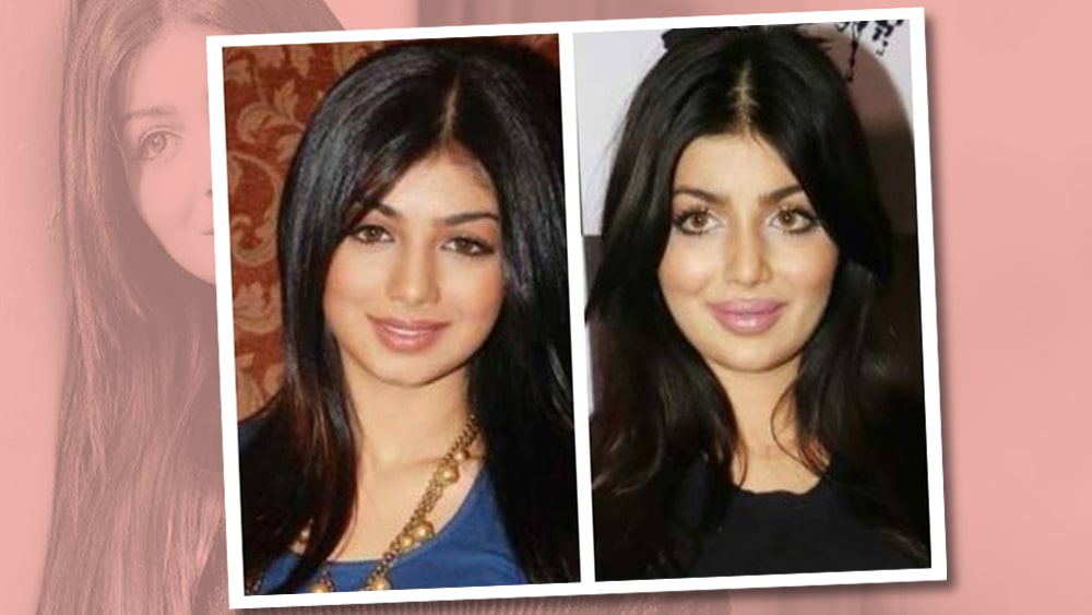 আয়েশা তাকিয়া: কেরিয়ার শুরু করেছিলেন ‘কমপ্ল্যান গার্ল’ হিসেবে। ধীরে ধীরে পা রাখেন সিনেমা জগতেও। ‘ডোর’, ‘ওয়ান্টেড’ সহ বেশ কিছু ছবি সাফল্যও লাভ করে বক্সঅফিসে। কিন্তু হঠাৎই ২০১৭ নাগাদ আয়েষার একটি ছবি সোশ্যাল মিডিয়ায় ভাইরাল হয়ে যায়। আঁতকে উঠেছিলেন তাঁর অনুরাগীরা। এ কোন আয়েষা! ‘বেবি ফেস’-এর জন্যই যিনি মূলত জনপ্রিয় ছিলেন, প্লাস্টিক সার্জারি করে একেবারেই নিজেকে বদলে ফেলেছেন তিনি। না বলে দিলে বোঝার উপায় নেই যে ইনিই আয়েষা। যদিও অভিনেত্রী দাবি করেছিলেন সোশ্যাল মিডিয়ায় তাঁর যে ছবিগুলো ঘুরছে সেগুলোর বেশিরভাগই ‘ফেক’, ভুয়ো।