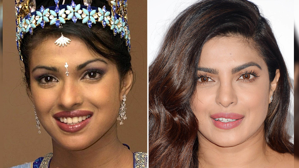 প্রিয়ঙ্কা চোপড়া: মিস ওয়ার্ল্ড জেতার সময়কার প্রিয়ঙ্কা আর এখনকার প্রিয়ঙ্কার চেহারার মধ্যে আকাশ-পাতাল ফারাক। বয়সের কারণে কিছুটা অমিল থাকবেই কিন্তু ভাল করে লক্ষ্য করলে দেখা যাবে পিগি চপসও লিপ জবের আশ্রয় নিয়েছেন। বদলে ফেলেছেন ঠোঁটের আকৃতি। যদিও এ বিষয়ে তাঁকে বারংবার প্রশ্ন করা হলে প্রত্যেকবারেই অস্বীকার করেছেন নিক-ঘরণী। বলি অভিনেত্রীদের মধ্যে তিনিই প্রথম যে লিপ জব করানোর সাহস দেখিয়েছিলেন।