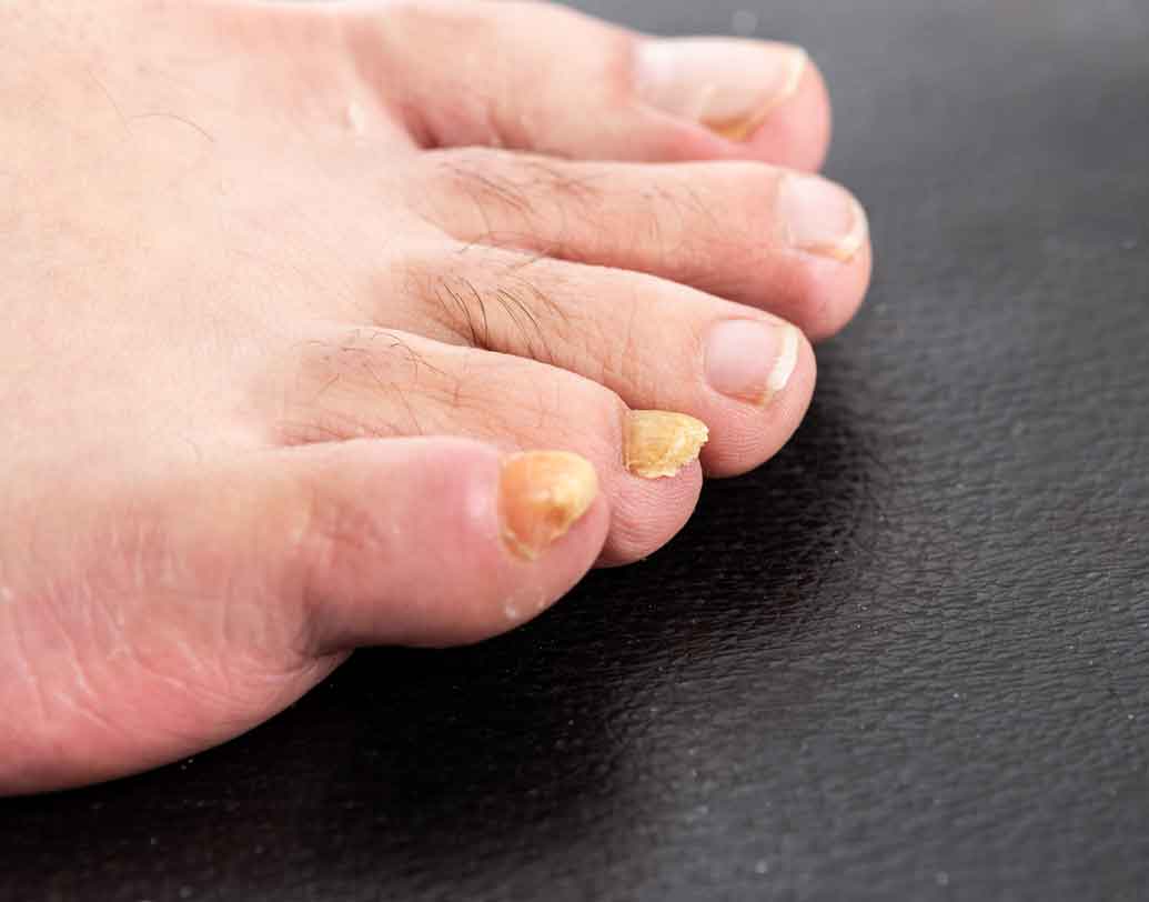 পায়ের আঙুলগুলি বয়সের সঙ্গে হলুদ হয়ে এলে তাকে স্রেফ ক্যালসিয়ামের অভাব বলে ধরবেন না। শ্বাসযন্ত্রে কোনও প্রকার সমস্যা দেখা দিলেও এমনটা হয়। তাই পায়ের নখ হলুদ হয়ে এলে দ্রুত চিকিৎসকের শরণ নিন।