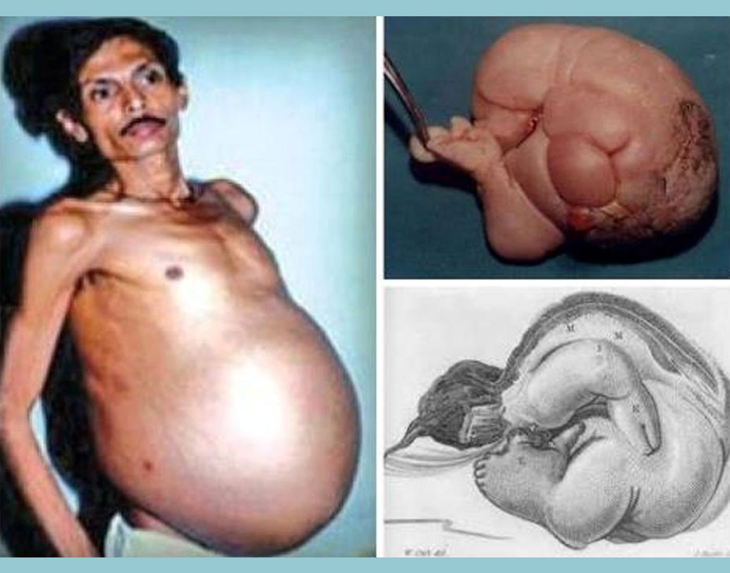 ছোট থেকেই সঞ্জু ভগতের পেটটা অনেকটা বাইরে ঝুলে থাকত। অনেকেই তাঁকে অন্তঃসত্ত্বা বসে খ্যাপাতেন। ৩৬ বছর বয়সে শ্বাসের সমস্যা শুরু হওয়ায় মুম্বইয়ের হাসপাতালে ভর্তি হন সঞ্জু। চিকিৎসকেরা ভেবেছিলেন তাঁর পেটে টিউমার হয়েছে। তবে অস্ত্রোপচারের সময় দেখা যায়, তাঁরই যমজ ভাইয়ের ভ্রূণ রয়েছে তাঁর শরীরে।