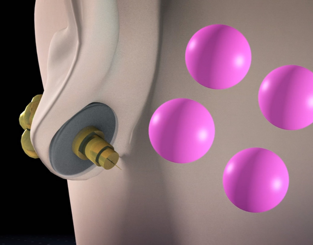 মার্কিন মুলুকের একটি সংবাদপত্রে প্রকাশ, প্রাথমিক পরীক্ষায় দেখা গিয়েছে যে গর্ভনিরোধক এই গয়না অবাঞ্ছিত গর্ভধারণ রোধে পর্যাপ্ত পরিমাণে হরমোন সরবরাহ করতে পারে।