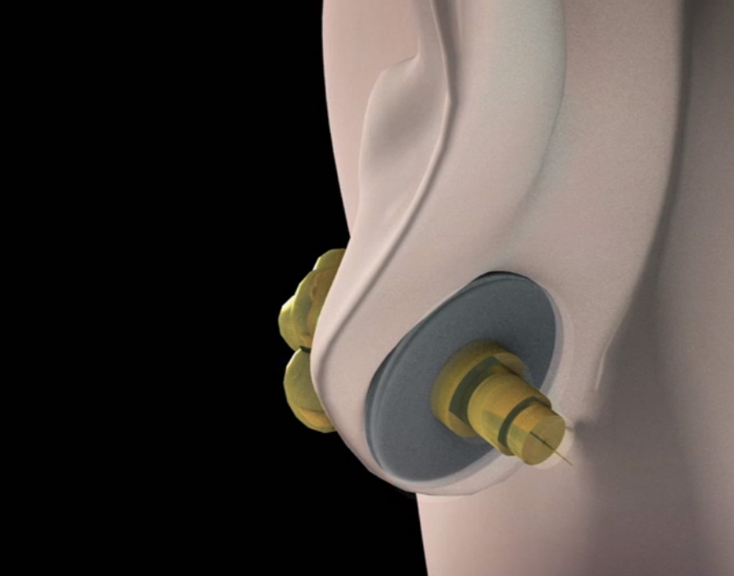 গর্ভনিরোধক গয়নার এই নতুন কৌশলটির লক্ষ্য হল, ব্যবহারকারীদের শারীরিক সুস্থতা ও ডোজের পরিমাণ নিয়ে গবেষণার মাধ্যমে এর মানকে আরও উন্নত করা।