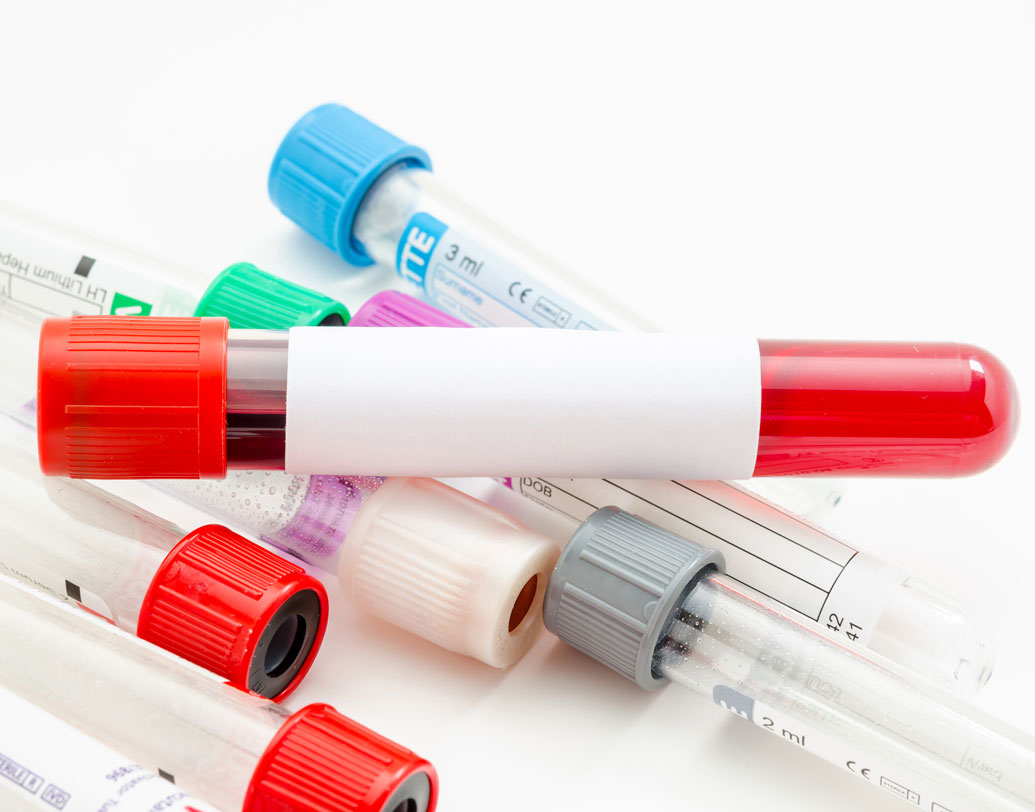 সাধারণত ১৫ বছর বয়স থেকে ৮৫ বছর বয়সিরা এই অসুখের মূল শিকার। মূলত মহিলারা এই অসুখে আক্রান্ত হন। তবে আধুনিক চিকিৎসাবিজ্ঞানের কথায়, মেয়েরা আক্রান্ত হলেও পুরুষদেরও উচিত বিভিন্ন অটো ইমিউন অসুখ থেকে দূরে থাকার।