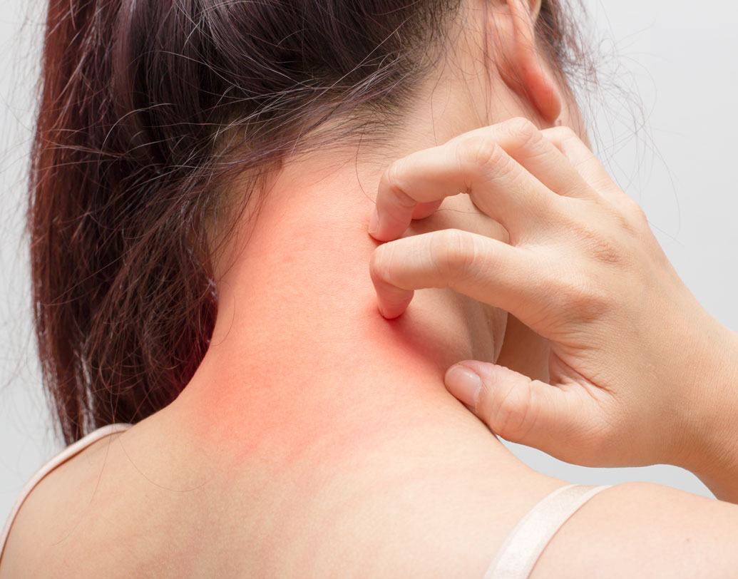 যাঁদের ত্বকে অ্যালার্জির প্রবণতা আছে, তাঁরাও আম খাওয়ায় নিয়ন্ত্রণ আনুন। এঁদের আম খেলে চোখ জ্বালা, হাঁচি, পেটে ব্যথা, ঠান্ডা লেগে যাওয়া ইত্যাদি সমস্যা আসতে পারে। তাই আম খাওয়ার আগে সচেতন থাকুন।