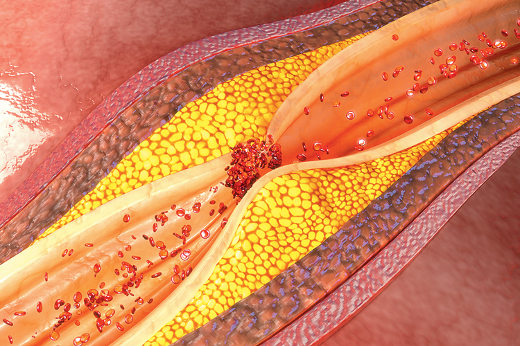 কোলেস্টেরল জমে রক্ত প্রবাহের পথে বাধা। শিল্পীর কল্পনায়। ছবি: আইস্টক