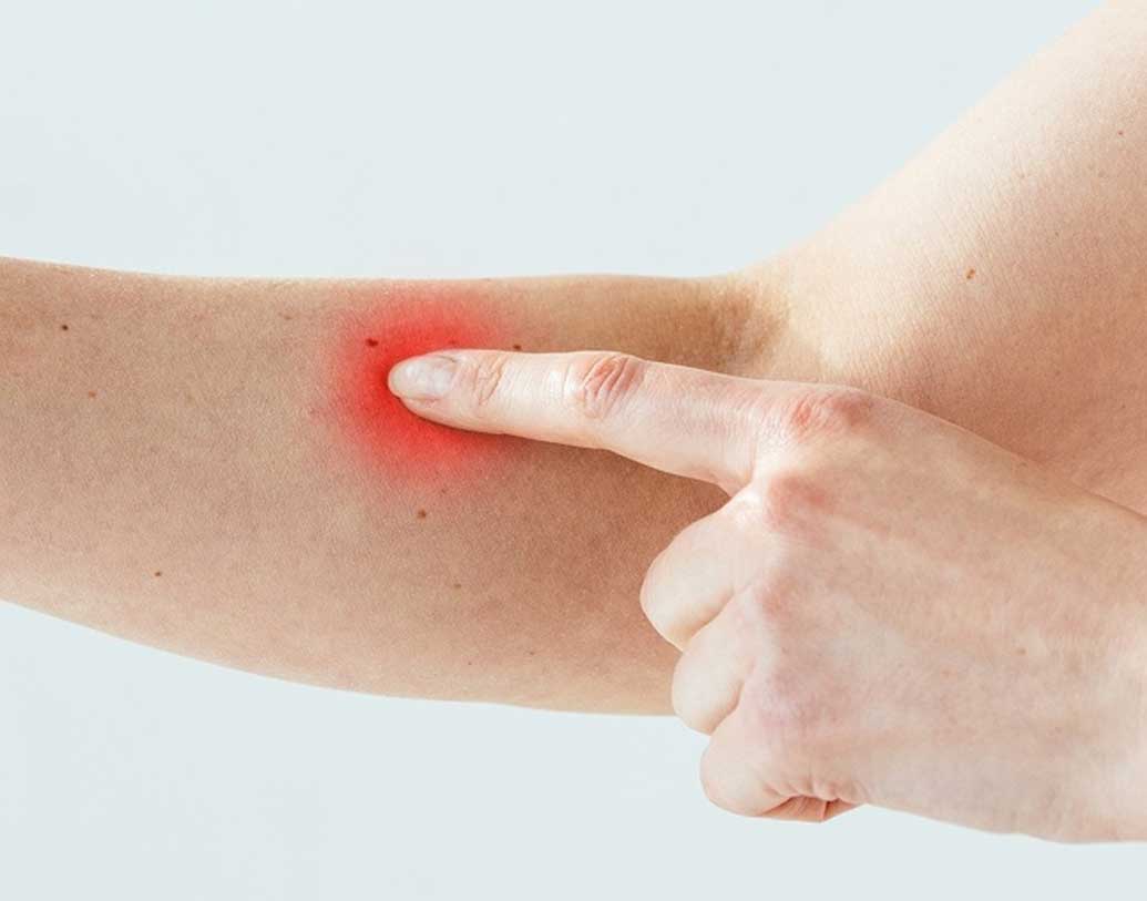 ফোস্কা: পুড়ে যাওয়া ত্বক দ্রুত স্বাভাবিক করে তুলতে এবং ফোস্কা এড়াতে পোড়া অংশের উপর হালকা চাপ দিন মাঝেমধ্যে। এতে ওই অংশে রক্ত চলাচল বাড়ে। ওই অংশের ত্বকের তাপমাত্রাও স্বাভাবিক থাকে, ফলে ফোস্কা পড়ে না।