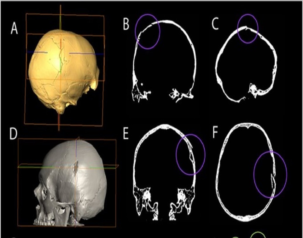 বিজ্ঞানীরা মাথার সামনের ছোট আঘাত দু’টিকে ব্যক্তির মৃত্যুর কারণ বলেই মনে করছেন। তবে মাথার পিছনের গভীর আঘাতটি মৃত্যুর আগের, না কি পরে হয়েছে তা নিয়ে সংশয় রয়েছে তাঁদের।