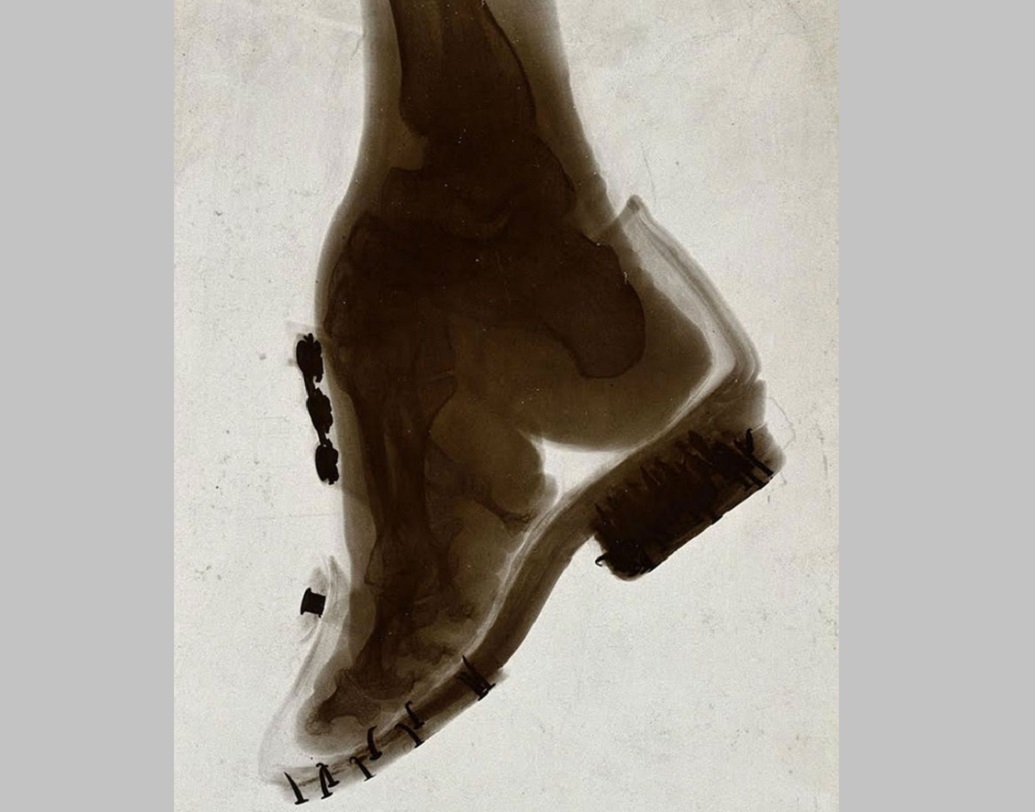 আবার রক্ত সঞ্চালন বন্ধ হয়ে গিয়ে পায়ে পচন ধরারও ঘটনা ঘটত অহরহ। কিন্তু এতেও রেহাই ছিল না। বরং তাতে খুশিই হতেন পরিবারের লোকজন। কারণ পায়ে পচন ঝরলে, আঙুল খসে পড়ে যাবে, তাতে পা আরও ছোট লাগবে। এর জন্য ব্যান্ডেজ বাঁধার সময় কেউ কেউ ইচ্ছাকৃত ভাবে কাপড়ের মধ্যে কাচের টুকরো বা আলপিন লাগিয়ে দিত যাতে যত তাড়াতাড়ি সম্ভব পায়ে পচন ধরে।