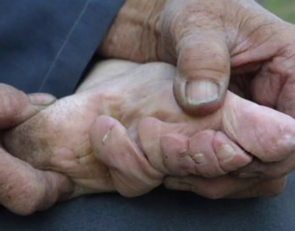 এতে অনেক সময়ই সংক্রমণ ছড়িয়ে পড়ত রক্তে। সেপটিক হয়ে মৃত্যুও হত কারও কারও। কিন্তু আঙুল ভাঙা, ব্যান্ডেজ বাঁধা ওই ছোট পা-কেই ‘সোনালী পদ্ম’-এর সঙ্গে তুলনা করা হত সেই সময়। মনে করা হত, পা যত শক্ত করে বাঁধা হবে, মেয়েদের যৌনাঙ্গও তত আকর্ষণীয় হয়ে উঠবে। তাতে সঙ্গমের সময় চরম আনন্দ পেতে পারবেন পুরুষরা। পুরুষের মন পেতে তাই মেয়েদের পা ছোট রাখতে বাধ্য করা হত।