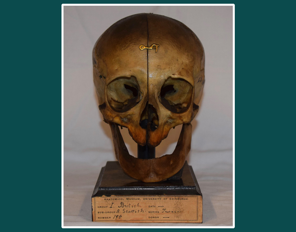 ১৮৩৩ সাল থেকে ইউনিভার্সিটি অব এডিনবরার অ্যানাটমিক্যাল মিউজিয়ামে রাখা ছিল ওই খুলিটি। প্রাচীন কালে ব্রিটেনে কেল্টিক জাতির মধ্যে ড্রুয়িড নামের বিশেষ এক গোষ্ঠীর মানুষের বাস ছিল। তাদের জীবনযাত্রা ছিল বেশ রহস্যময়।