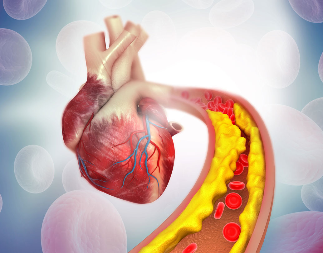 এক জন সুস্থ সবল মানুষের রক্তে কোলেস্টেরলের মাত্রা হওয়া উচিত প্রতি ডেসিলিটারে ১৬০ মিলিগ্রামেরও কম। জানেন, কী কী অভ্যাস আয়ত্তে আনলে সহজেই খারাপ কোলেস্টেরলকে ছেঁটে ফেলতে পারবেন শরীর থেকে?