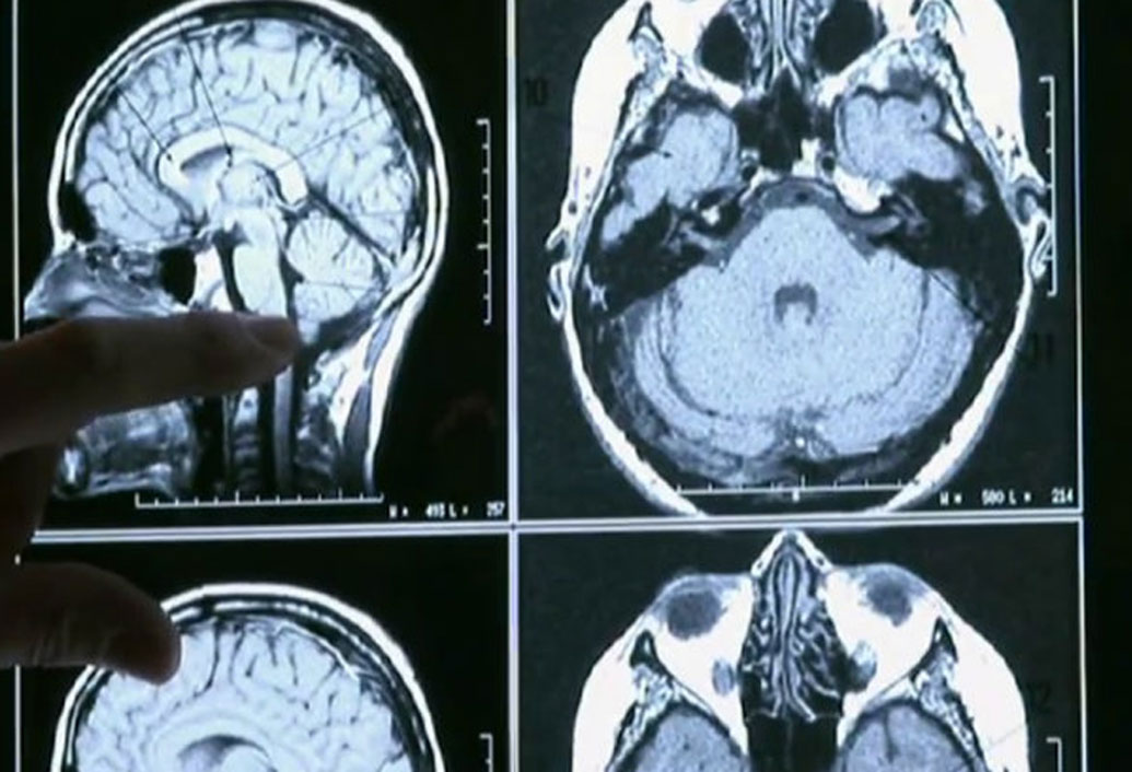 এই রোগে তাঁদের সেরিবেলার হাইপোপ্লাসিয়া অর্থাৎ দেহের ভারসাম্য নষ্ট হয়ে যায়। ফলে মানুষ সোজা হয়ে দাঁড়াতেই পারেন না। বায়োলজি জার্নাল প্লস-এ এই তথ্য প্রকাশিত হয়েছে।