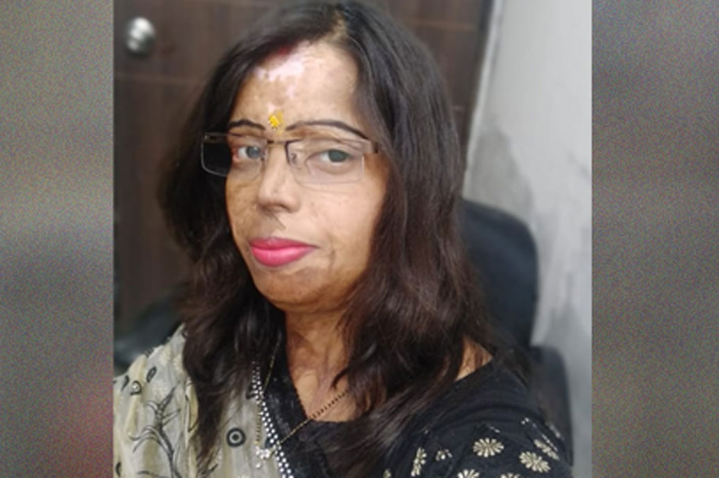 মোহিনীর পাশে হেঁটে চলা তাঁর বাবাও আর্তনাদ করছিলেন, তবে মোহিনীর থেকে অনেকটাই কম। মোহিনীর গায়ে লেগে কিছুটা অ্যাসিড তাঁর গায়েও লেগেছিল। সে কারণেই তাঁরও শরীরের অনাবৃত অংশের কিছু জায়গায় অ্যাসিডে পুড়ে যায়। মোহিনীর থেকে ক্ষতির পরিমাণ তাঁর অনেকটই কম।