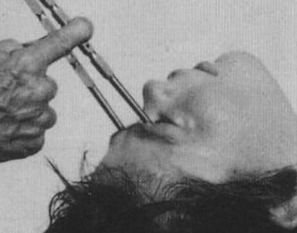 সঙ্গে চলত ইলেকট্রিক শক দেওয়ার মতো মধ্যযুগীয় চিকিৎসারীতি। এ ছাড়াও মস্তিষ্কের সম্মুখ ভাগে ( প্রিফন্টাল লোব) –এ লোবটমির মতো বর্বরোচিত চিকিৎসা পদ্ধতি অনেক সময়েই স্কিৎজোফ্রেনিক রোগীদের হ্যালুসিনেশন বন্ধ করার জন্য ব্যবহার করা হতো। ওই অত্যাচার সহ্য করতে না পেরে সে সময় অনেক রোগীর মৃত্যু হয়। কেউ কেউ বেছে নেন আত্মহত্যার পথ।