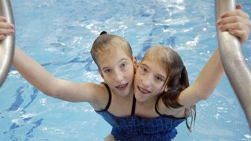 তাঁদের মা প্যাটি হেনসেল যখন হাসপাতালে ভর্তি হয়েছিলেন, তিনি জানতেন তাঁর শরীরে একটি ভ্রূণই বেড়ে উঠছে। কিন্তু চিকিৎসকেরা তাঁকে যমজ সন্তান উপহার দেন। অ্যাবি এবং ব্রিটনি-দুই বোন।