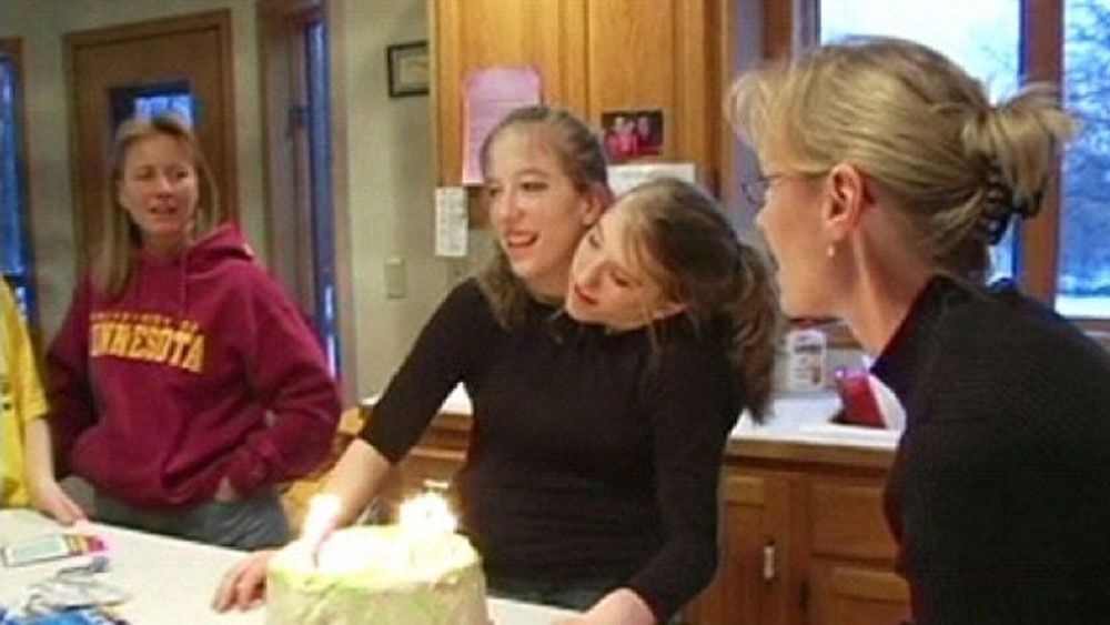 আরও বিস্ময়ের বিষয় হল, একজনের জ্বর হলেই যে অন্যজনের জ্বর হবে তা কিন্তু নয়। দু’জনের শরীর এক হলেও অসুখ-বিসুখ বেশির ভাগ সময়ই একসঙ্গে হয় না!