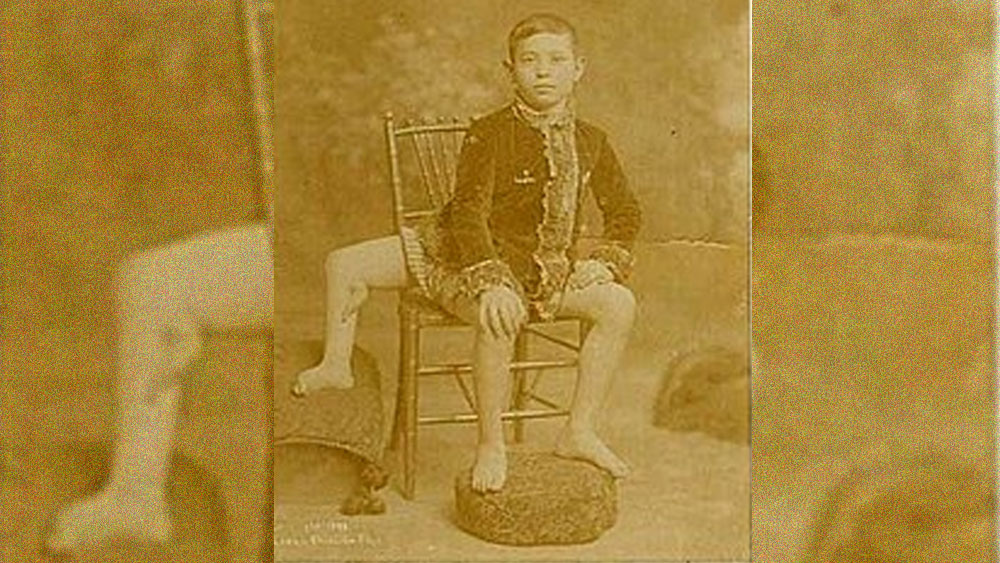 ফ্রাঙ্ক জন্ম নিয়েছিলেন প্যারাসিটিক টুইন হিসাবে। এই ক্ষেত্রে তাঁর  শরীরে যমজ সন্তানের পা এবং যৌনাঙ্গ সংযুক্ত অবস্থায় ছিল। ফলে অদ্ভুত আকার নিয়ে জন্ম হয়েছিল ফ্রাঙ্কের।