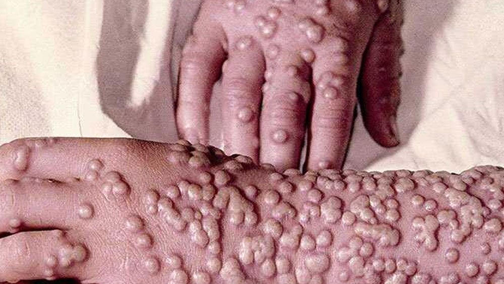 এমনকী একই ভাবে সাইবেরিয়ায় বরফের তলা থেকে গুটি বসন্ত এবং বিউবোনিক প্লেগ-এর ভাইরাসও মিলেছে। ১৮৯০ সালে সাইবেরিয়াতে মহামারি আকার নিয়েছিল গুটি বসন্ত। ৪০ শতাংশ জনবসতি সাফ হয়ে গিয়েছিল এই রোগে।