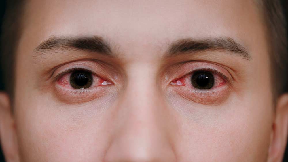 ব্যাকটিরিয়ার সংক্রমণ ঘটে চোখ লালচে হয়ে যাচ্ছে। ঘন ঘন চুলকোচ্ছে। কখনও বা ব্যথাও থাকছে। অন্য সময় হলে একে কনজাংটিভাইটিস বলে দেগে দিয়ে নিশ্চিন্ত হওয়া যেত। কিন্তু এখন এতটা নিশ্চিন্ত হওয়া যাচ্ছে কই! ‘দ্য জার্নাল অব দ্য আমেরিকান অ্যাকাডেমি অব অপথ্যালমোলজি’-তে প্রকাশিত খবর অনুযায়ী, মোট কোভিড আক্রান্ত মানুষের মধ্যে ১-৩ শতাংশের এই সমস্যা হয়।