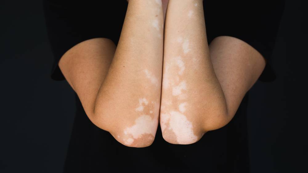Image of vitiligo 