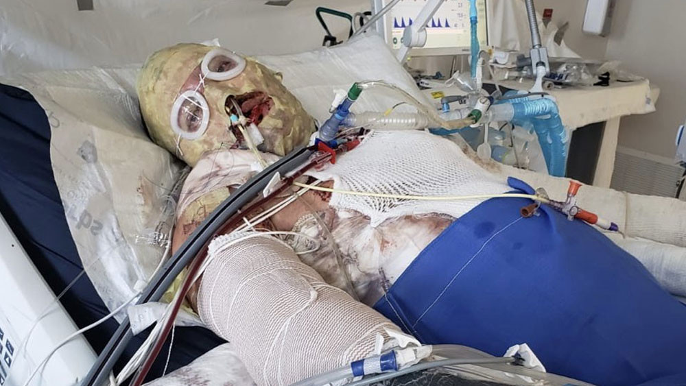 ঘটনার পর প্রথম ২০ দিন কোমাতেই কাটে অ্যালেক্সিসের। তার পরের ২ মাস আইসিইউ-তে। শরীরে ১৯টি অস্ত্রোপচারের পর কিছুটা সুস্থ হন তিনি।