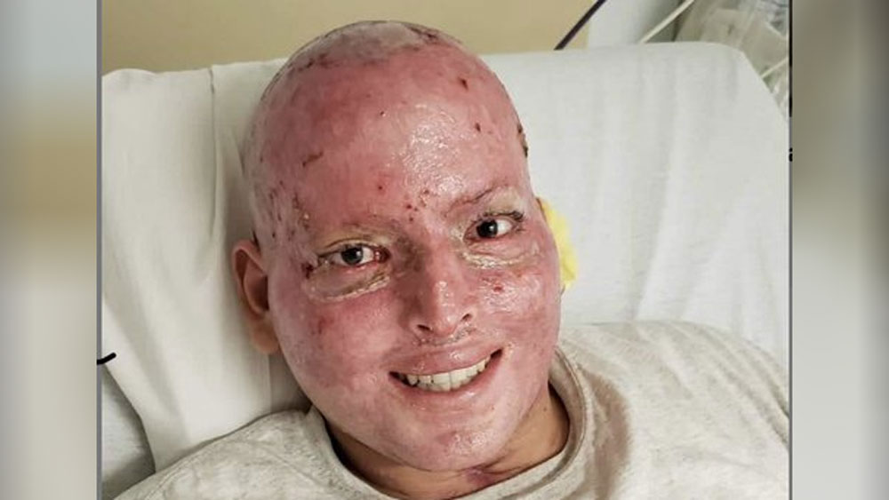 কিন্তু বাড়ি পৌঁছনোর কয়েক দিনের মধ্যেই তাঁর হাতে এসে পৌঁছয় হাসপাতালের চিঠি। তাতে লেখা, চিকিৎসার খরচ বাবদ হাসপাতাল অ্যালেক্সিসের থেকে ২০ লাখ ডলার টাকা পায়। ভারতীয় মুদ্রায় যা প্রায় ১৫ কোটি টাকা। এই টাকা দ্রুত পরিশোধ করতেও বলা হয় তাঁকে।