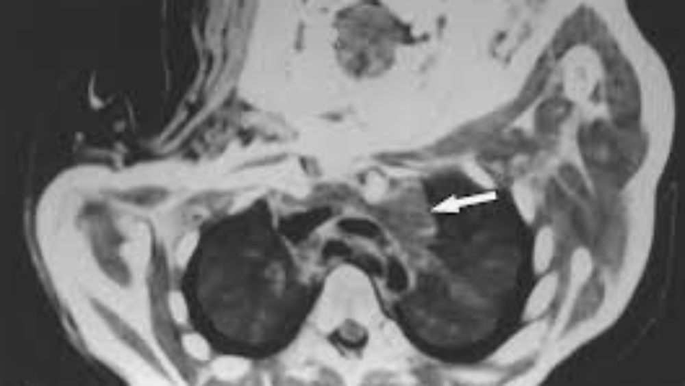 ওই তিন জনেরই ভিতরের অঙ্গ-প্রত্যঙ্গগুলিতেও সে ভাবে পচন ধরেনি। এক জনের হৃৎপিণ্ডে আবার এত বছর পরেও জমাট বাঁধা রক্ত মিলেছে। এর কারণ ব্যাখ্যা করে বিশেষজ্ঞেরা জানিয়েছেন, তাদের শরীরে ডিহাইড্রেশন শুরুর আগেই তারা মমি হয়ে গিয়েছিল।