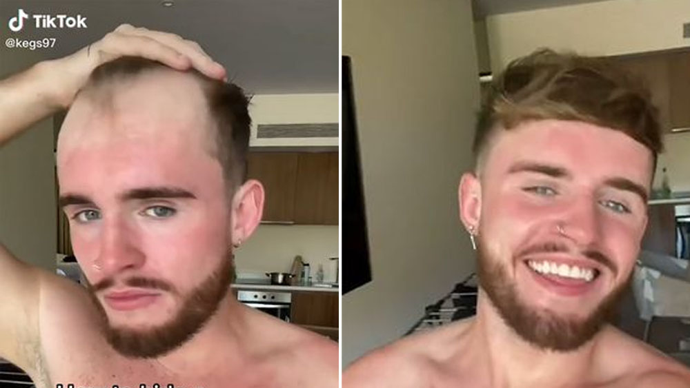 (বাঁদিকে) কেগস-এর চুলের প্রকৃত অবস্থা। (ডানদিকে) টাক ঢাকার পড়ে। 