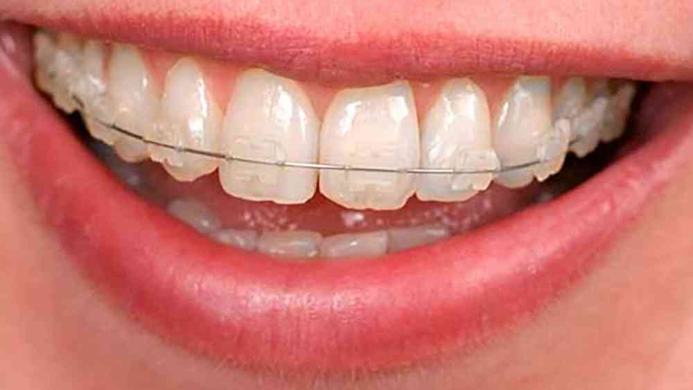 সেরামিকের ব্রেসেস