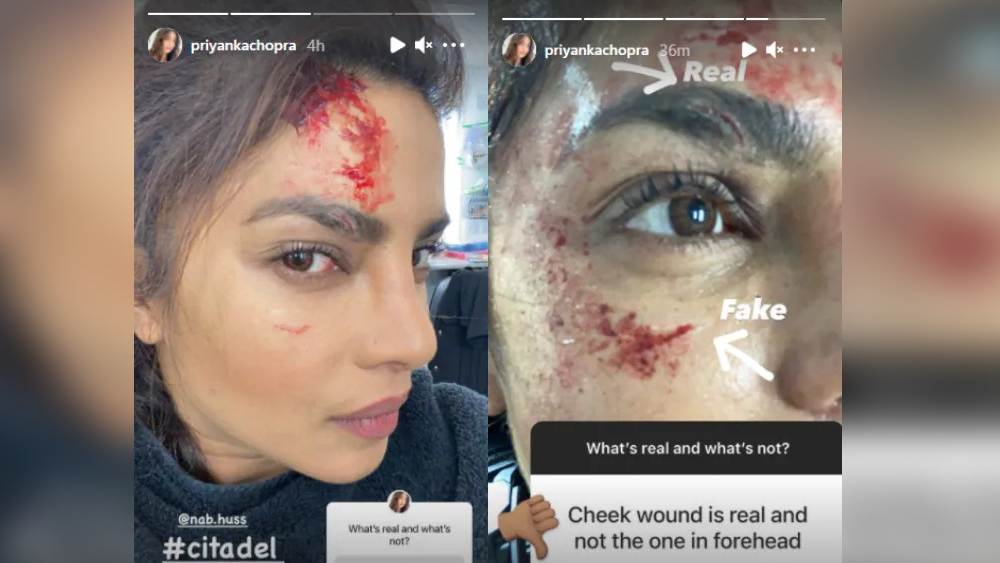 প্রিয়াঙ্কার চোট