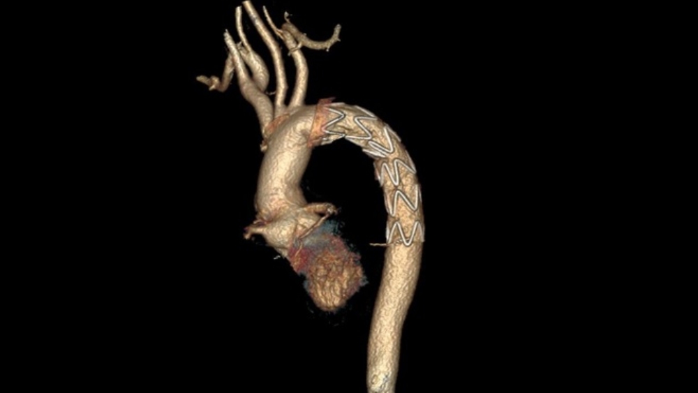 ‘ফ্রোজেন এলিফ্যান্ট ট্রাঙ্ক’ পদ্ধতিতে চিকিৎসা।