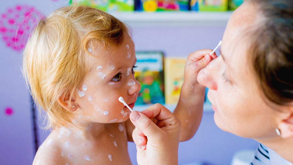 জলবসন্ত রোগে আক্রান্তরা ত্বকে জ্বালা ভাব বোধ করেন। যা কখনও কখনও অসহ্য হয়ে দাঁড়ায়। জলের সঙ্গে বেকিং সোডা মিশিয়ে পেস্ট বানিয়ে তা ত্বকে বের হওয়া র‍্যাশের উপর লাগালে অনেকটাই আরাম পাওয়া যায়।