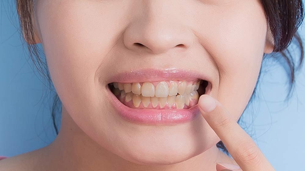 যে ভাবে টুথব্রাশের উপর টুথপেস্ট লাগান, একেবারে সে ভাবেই জল মিশিয়ে বেকিং সোডার পেস্ট বানিয়ে নিন। এ বার রোজ সেটি দিয়েই দাঁত পরিষ্কার করুন। কয়েক দিন টানা এ ভাবে করলেই দাঁতে জাদু দেখতে পাবেন। হলুদ দাঁত অনেকটাই সাদা হয়ে যাবে।