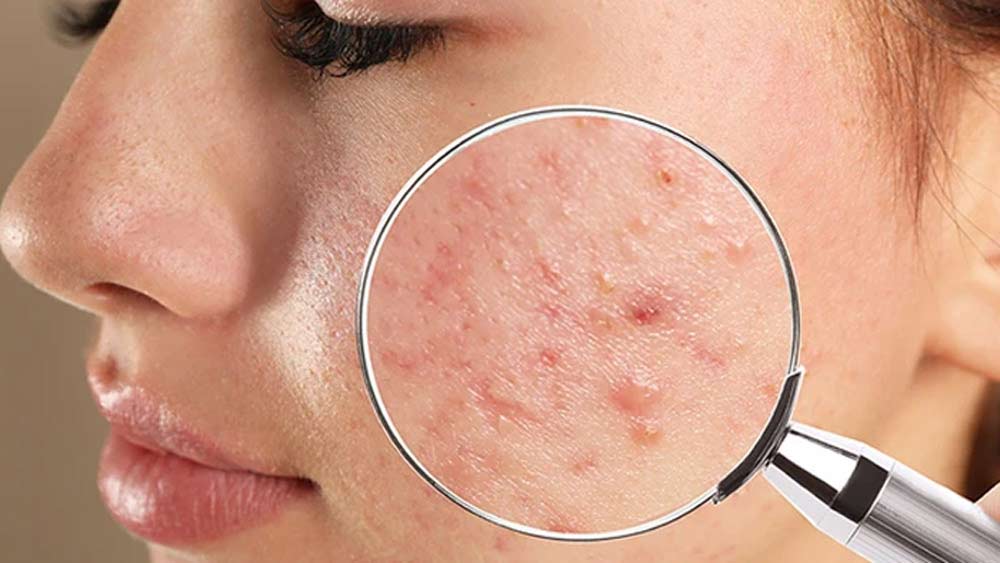 যাঁদের ব্রণর সমস্যা থাকে তাঁরাও এই পদ্ধতিতে উপকৃত হয়ে থাকেন। চামড়ার নীচে থাকা সিবেসিয়াস গ্রন্থির নিঃসরণ কমিয়ে দেয় এই আলো।