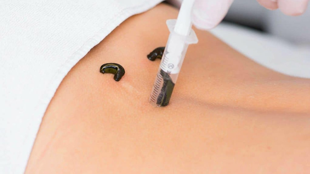 ব্যথা কমাতে কাজে লাগে জোঁক। 