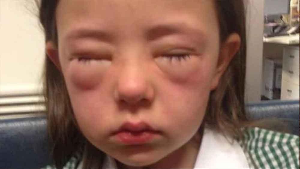 স্যানতাল জানিয়েছেন, তাঁর মেয়ের কান, চোখ এমনকি গলাও ফুলে উঠেছিল। সারা শরীর ভরে গিয়েছিল হাইভস বা এক ধরনের লালচে র‌্যাশে। দম বন্ধ হয়ে আসছিল বনির। দু’হাতে গলা ধরে মায়ের কাছে ছুটে এসেছিল সে।