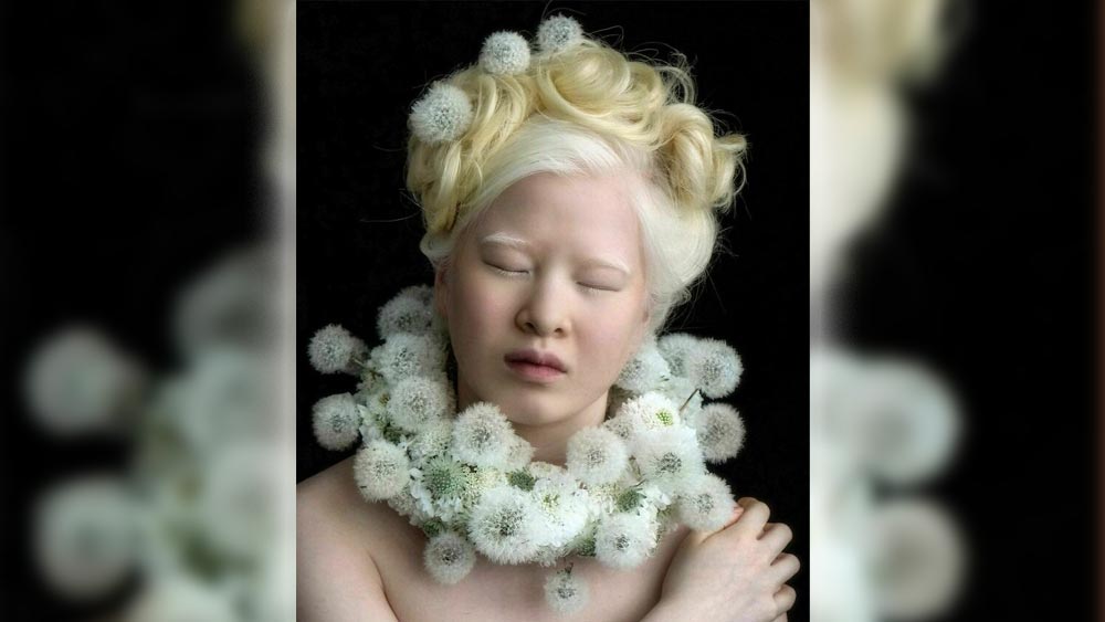 বিরল জিন রোগ অ্যালবিনিজমে আক্রান্ত হন প্রতি ১৭ হাজারে একজন। হুয়েই জানিয়েছেন, এই রোগে আক্রান্তদের রীতিমতো ঠাট্টা করা হয়। অনেক সময় ভূত, ভিন্‌গ্রহী জাতীয় মন্তব্যও করা হয়। কিন্তু শারীরিক প্রতিবন্ধকতা নিয়েও যে শীর্ষে যাওয়া যায় নিজের মডেলিংয়ের মধ্যে দিয়ে তাঁর সেই বার্তা পৌঁছে দিতে চান তিনি।