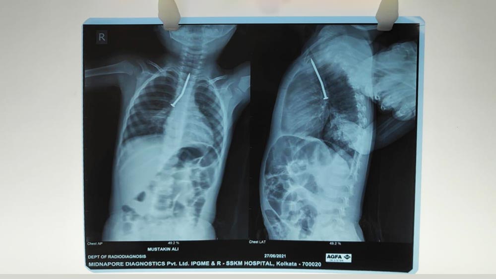 রিজিড ব্রঙ্কোস্কপি পদ্ধতিতে অস্ত্রোপচার হয় বলে জানিয়েছেন এসএসকেএম কর্তৃপক্ষ।