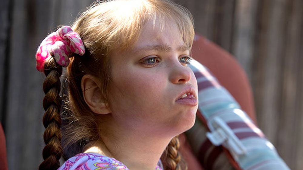 এই বিরল জিনগত রোগে আক্রান্তদের ক্ষেত্রে দেখা গিয়েছে, জিনগত ভাবে তারা পুরুষ হওয়া সত্ত্বেও বয়ঃসন্ধি পর্যন্ত তাদের মধ্যে পুরুষের বাহ্যিক বৈশিষ্টগুলি (যেমন পুরুষের লিঙ্গের বৃদ্ধি, পেশির গঠন ইত্যাদি) প্রকাশ পায় না। তার পর ধীরে ধীরে তা প্রকাশ পেতে শুরু করে।