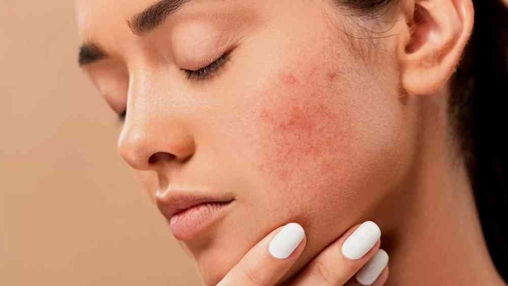 অতিরিক্ত মিষ্টি খেলে হতে পারে এগজিমা, সোরিয়াসিসের মতো ত্বকের অসুখ।