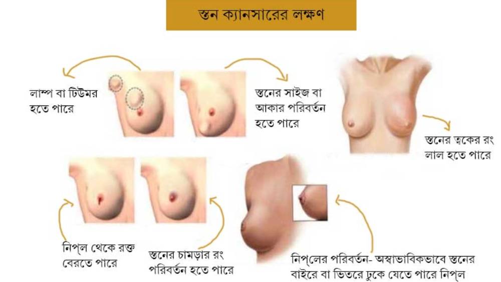 Breast Cancer  Bengali Scientists Show Way To Cure Triple Negative Breast  Cancer dgtlx - Anandabazar