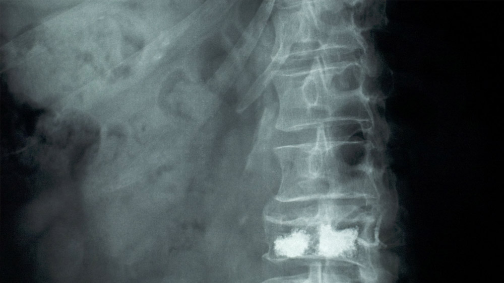 ২০১৭ সালে মোটরবাইক দুর্ঘটনায় শিরদাঁড়ার একাধিক হাড়ে চিড় ধরে গিয়েছিল ইন্দুবেনের। সেখানকার স্নায়ুতেও সমস্যা দেখা দিয়েছিল। চিকিৎসকদের পরামর্শ ছিল, পুরোপুরি শয্যাশায়ী হয়ে থাকতে হবে। তা না হলে তাঁর পিঠের সমস্যা চিরকালের জন্য নিয়ন্ত্রণের বাইরে চলে যাবে।