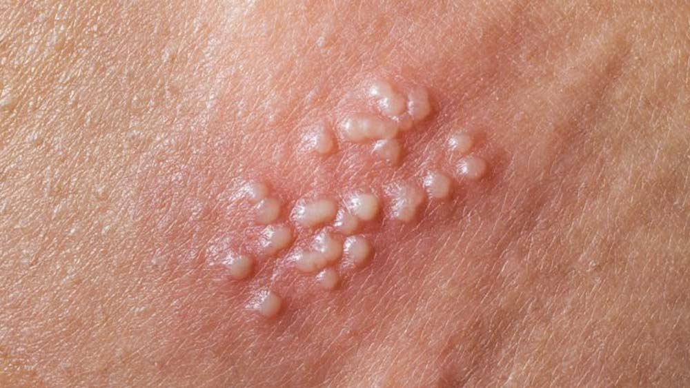 ‘সানবার্ন’ হলে ত্বকের আক্রান্ত জায়গাটিতে চিকিৎসকের পরামর্শ না নিয়ে কিছু না লাগানোই ভাল। ফুসকুড়ি হলে তা ফাটানোর কোনও চেষ্টা যেন করা না হয়। বদলে চড়া রোদে না থাকা, ঠান্ডা জলে ভেজানো কাপড় ত্বকের উপর রাখা, তার পরও না কমলে চিকিৎসকের পরামর্শ নিতে বলেছেন বিশেষজ্ঞরা। 