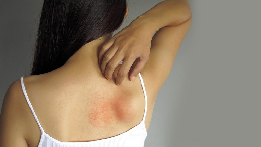 গরমে ত্বক লাল হয়ে যেতে পারে। অনেকটা অংশ জুড়ে র‌্যাশ বেরতে পারে। একে ‘হিট র‌্যাশ’ বলা হয়। ‘হিট র‌্যাশ’ এড়াতে সানস্ক্রিন ব্যবহার করতে হবে। রোদ এড়িয়ে ছায়া বা ঠান্ডা জায়গায় থাকলে এই সমস্যা এড়ানো যেতে পারে।